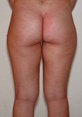 avant la liposuccion des cuisses