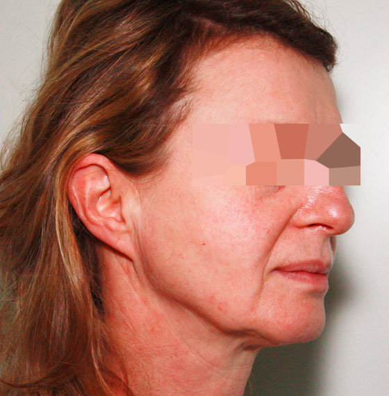 avant l'opération de lifting cervicofacial