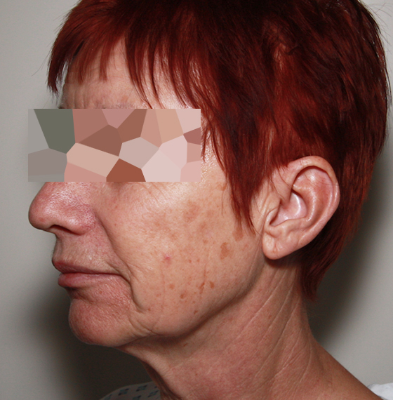 avant l'opération de lifting cervicofacial