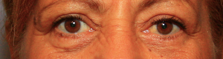 après l'opération de blépharoplastie
