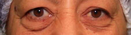 avant l'opération de blépharoplastie