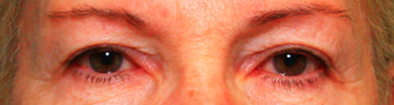 avant l'opération de blépharoplastie
