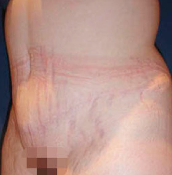 après l'opération d'abdominoplastie