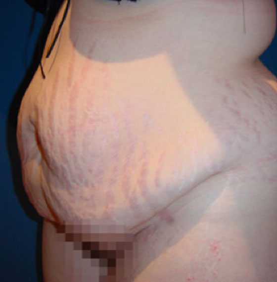 avant l'opération d'abdominoplastie